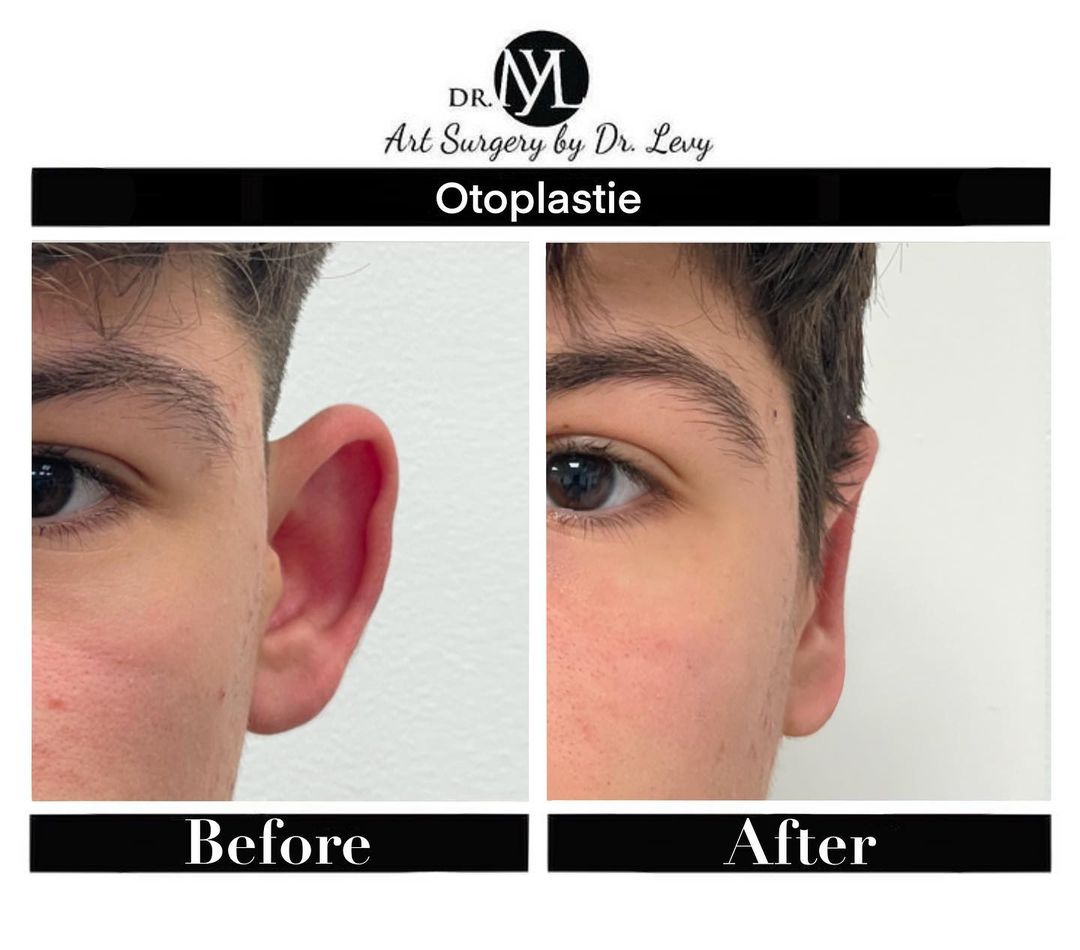 otoplastie bucuresti